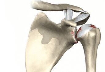 Articolazione della spalla colpita da osteoartrosi