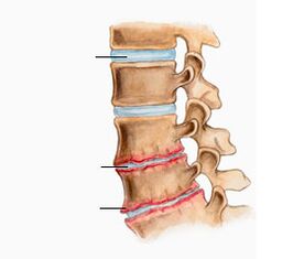 Osteocondrosi