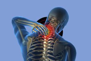 Sintomi di osteocondosi cervicale