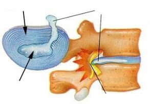 Distruzione dell'anello fibroso nell'osteocondrosi cervicale