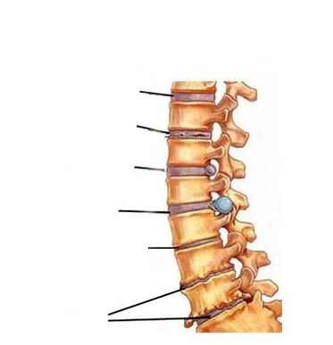Fasi di sviluppo dell'osteocondrosi