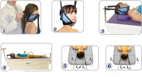 Trattamento dell'osteocondrosi cervicale mediante trazione