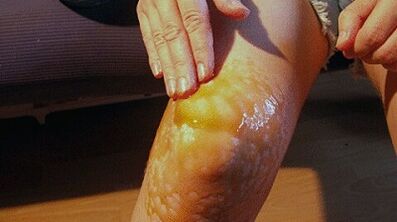 Strofini per il trattamento dell'osteoartrosi dell'articolazione del ginocchio