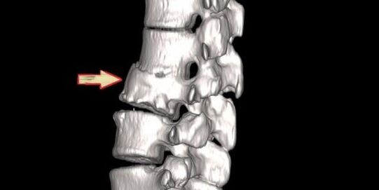 Patologia spinale come causa di mal di schiena