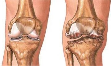 Osteoartrosi del ginocchio