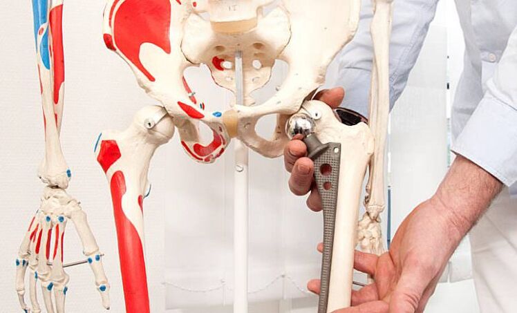 Artroplastica dell'anca per il dolore