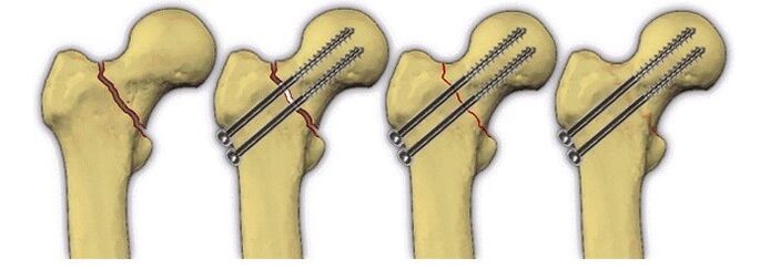 Fissaggio del corpo osseo con perni per il dolore all'articolazione dell'anca