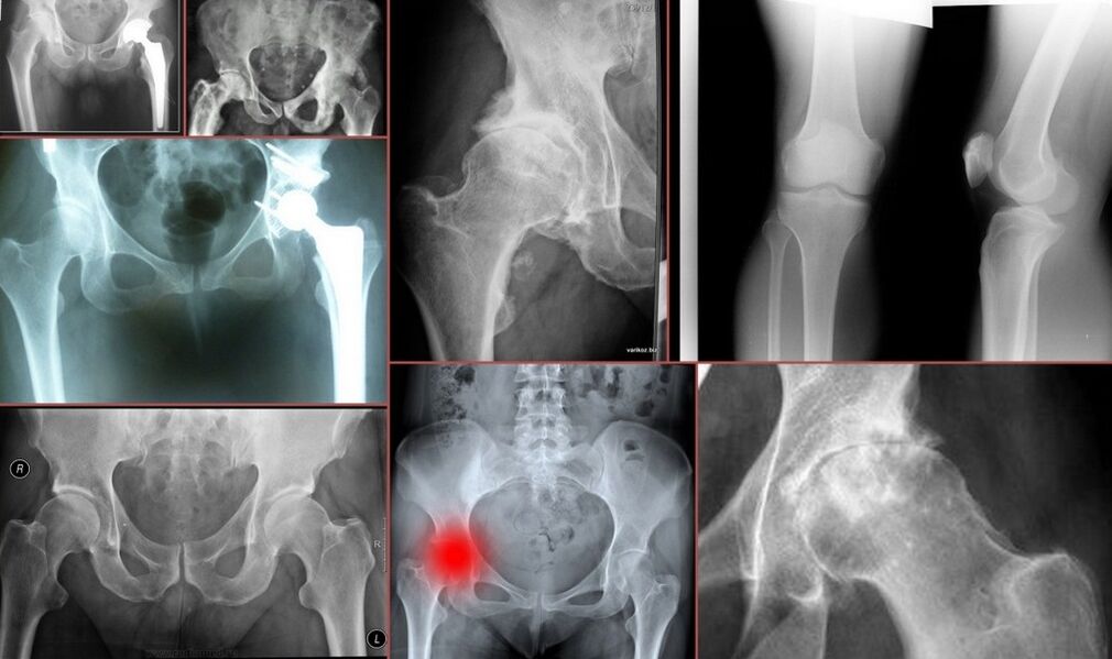 Radiografia per il dolore all'anca