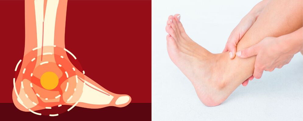 Il dolore nell'artrosi deformante della caviglia è accompagnato da gonfiore e ridotta mobilità delle articolazioni