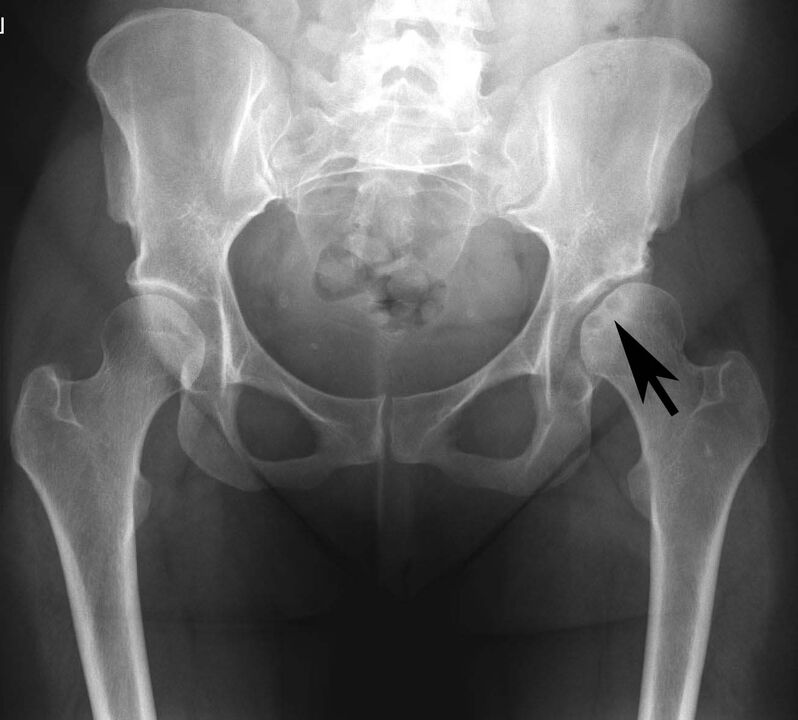 Deposizione di sali di calcio nell'articolazione dell'anca con pseudogotta nella radiografia