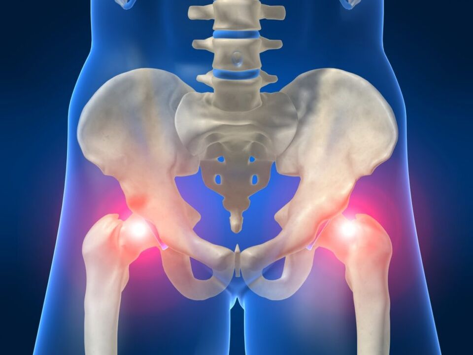 Il dolore su entrambi i lati dell'articolazione dell'anca è inquietante nella malattia di Bechterew