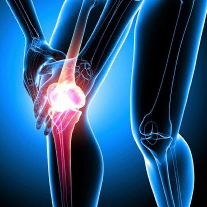 L'artrite reumatoide in stadi avanzati può causare dolore all'anca