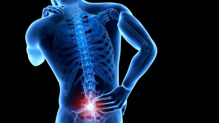 Mal di schiena con osteocondrosi lombare